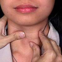 Лечение зоба щитовидной железы у женщин